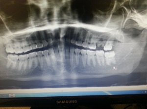 X-Rays of my teeth